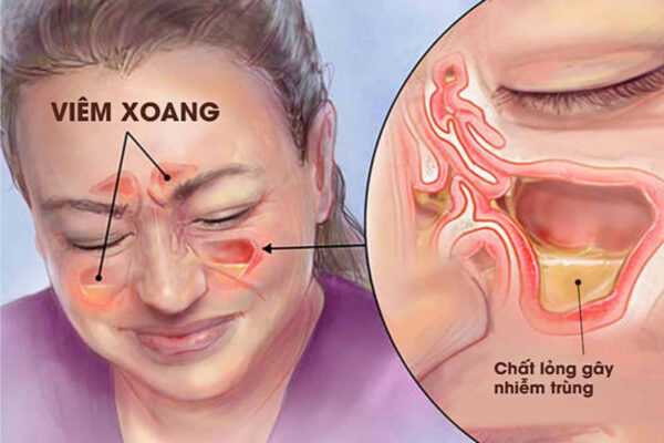 Tìm hiểu về thuốc viêm xoang mũi dị ứng hiệu quả nhất
